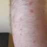 Quelques piqûres de midges...